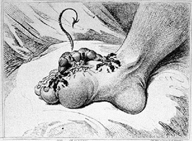 artistic depiction of gout